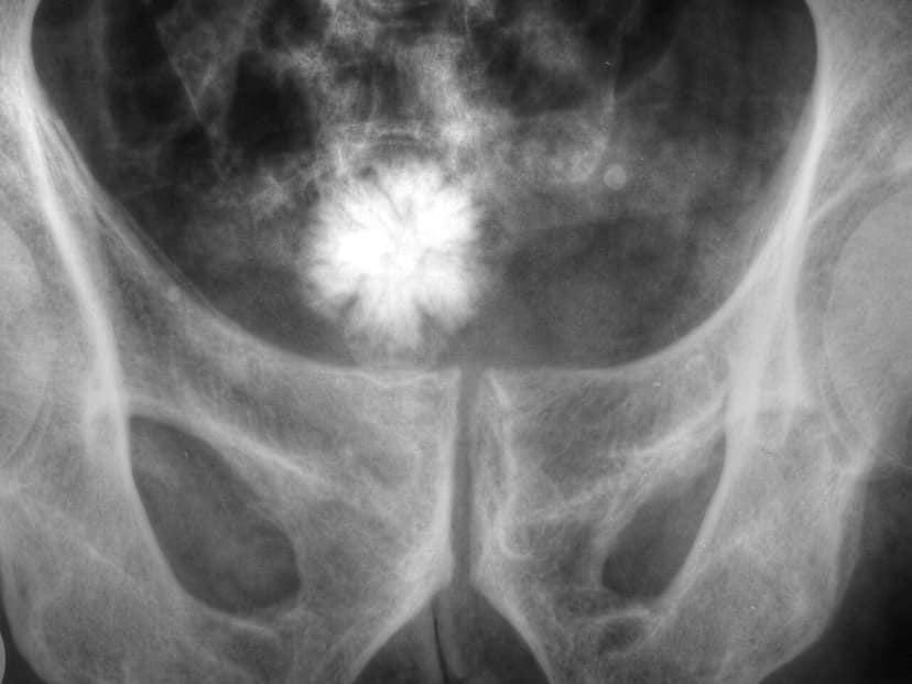 Sri-lankisches Krankenhaus entfernt 3,1 kg Harnblasenstein – Rekordanspruch
